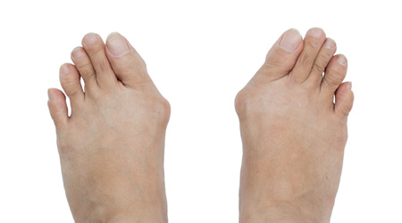 Bunions